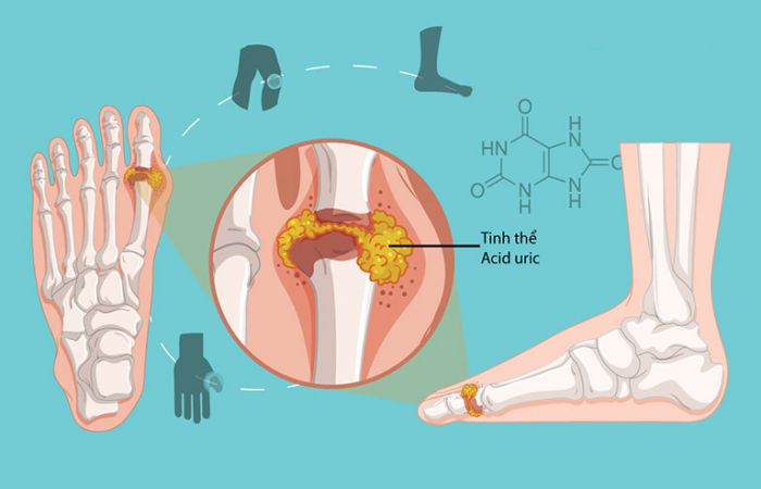 Chỉ số uric acid trong máu cao cảnh báo cơ thể có nguy cơ mắc bệnh gout