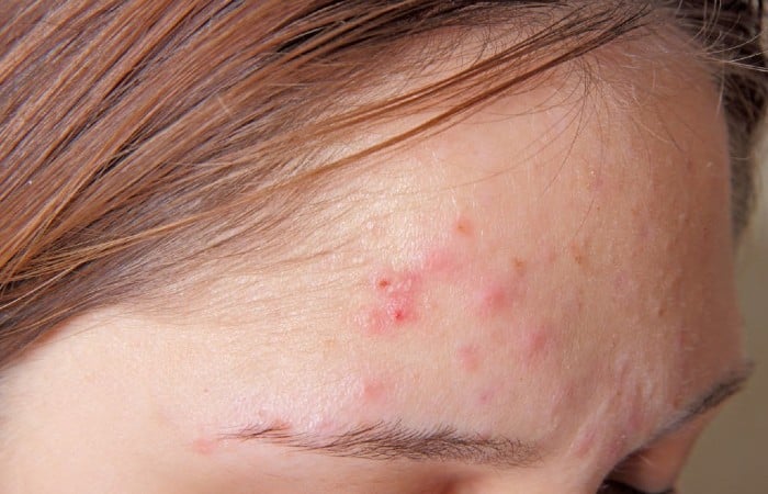 Da bị mụn trứng cá nên dùng thực phẩm chức năng trị mụn có vitamin B2, B6 và C