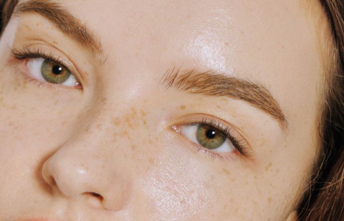 Melanin sản sinh quá mức gây ra hiện tượng thâm nám trên bề mặt da