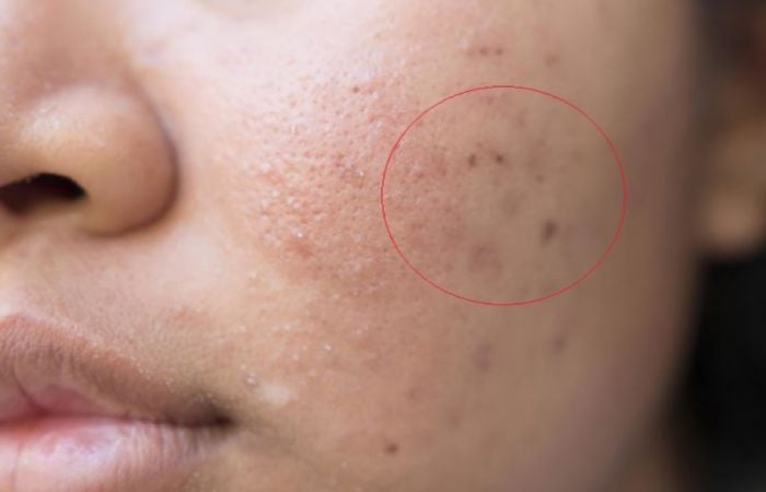 Nếu da không được chăm sóc kỹ lưỡng sẽ hình thành sẹo thâm