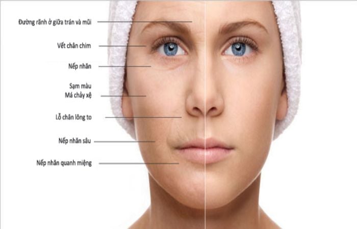Lượng collagen tự nhiên trong cơ thể sẽ giảm dần theo thời gian là nguyên nhân gây lão hóa da