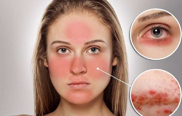 Da nhạy cảm là làn da dễ lão hóa nhất