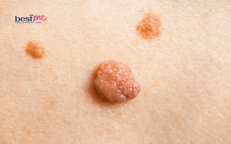 11 cách dùng lá tía tô trị mụn thịt hiệu quả cực kì bất ngờ - 1