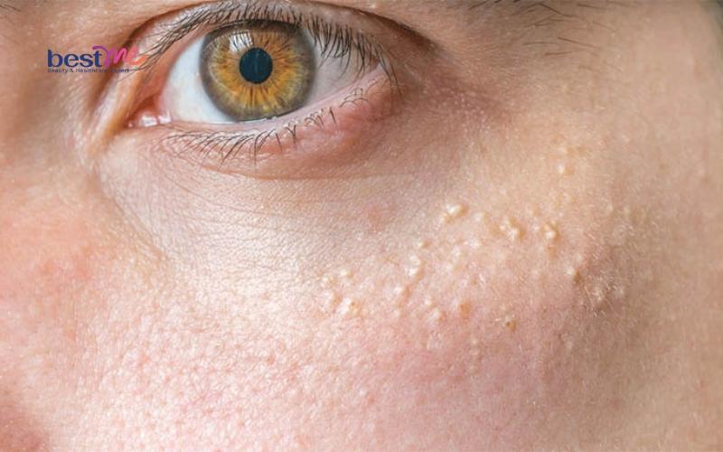 11 cách dùng lá tía tô trị mụn thịt hiệu quả cực kì bất ngờ - 8