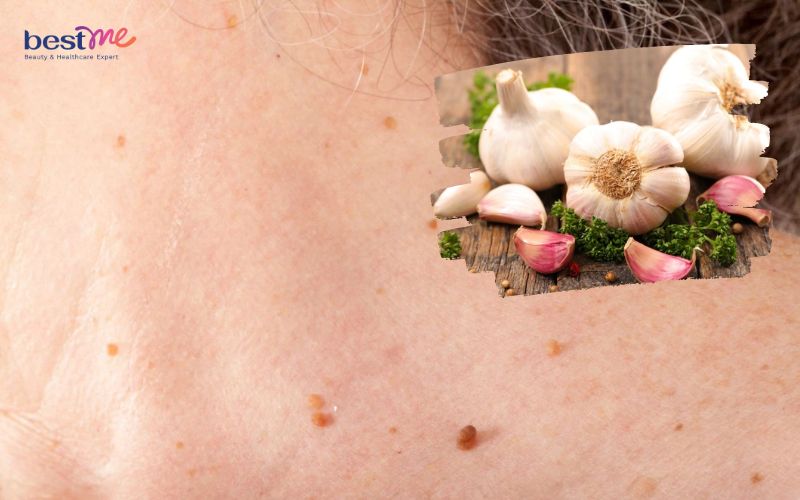 11 cách trị mụn thịt bằng tỏi hiệu quả triệt để nhất tại nhà - 12