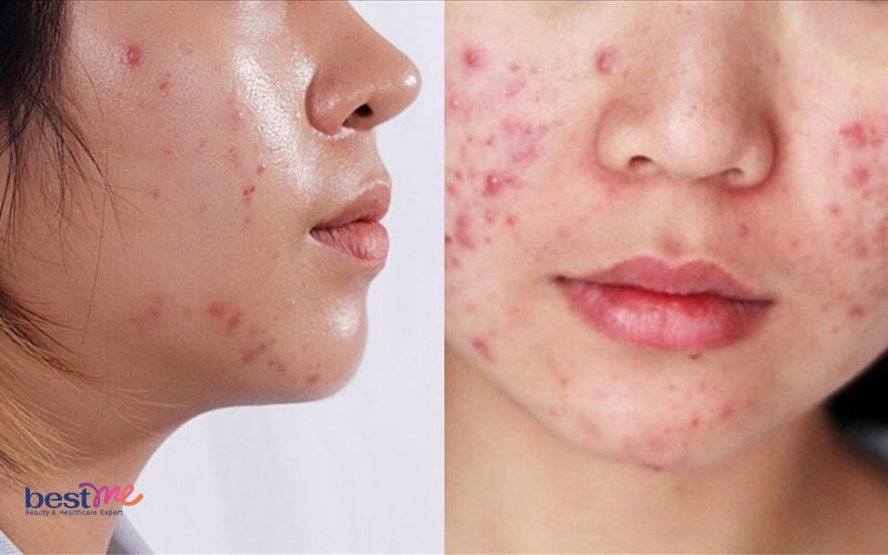 15-cach-tri-mun-tham-cho-da-dau-tai-nha-hieu-qua-ngo-ngang-1 15 cách trị mụn thâm cho da dầu tại nhà hiệu quả ngỡ ngàng - 1