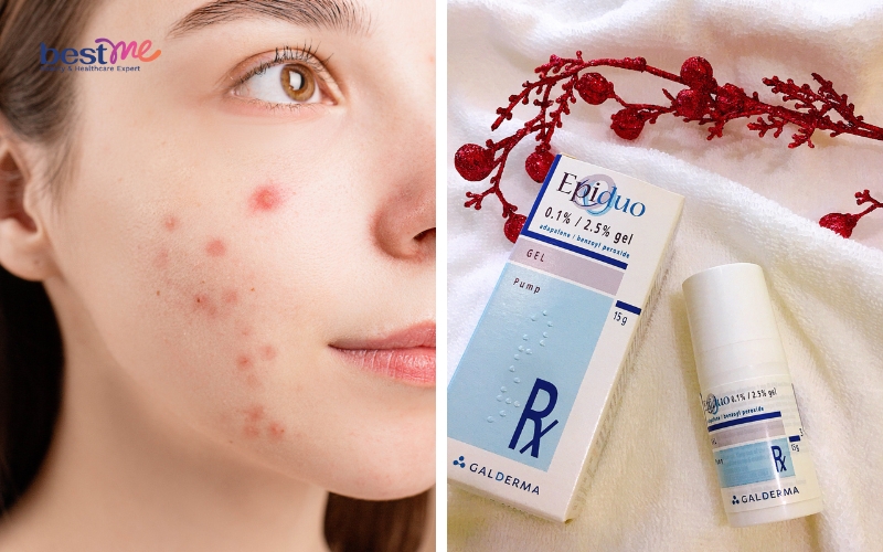 19 loại kem thuốc trị mụn nhọt hiệu quả tốt nhất [Có giá] - 13