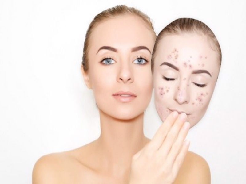 Những nhầm tưởng tai hại khi trị mụn ẩn