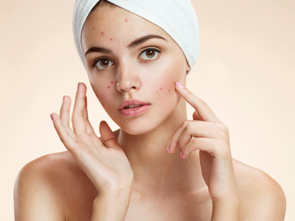 sản phẩm điều trị mụn