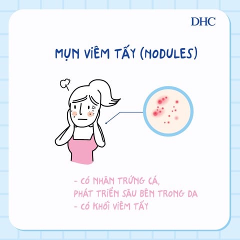 trị mụn viêm tấy