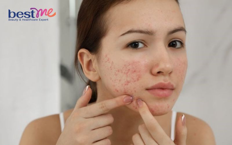 an-banh-trang-co-noi-mun-khong-cach-an-tot-nhat-khong-bi-mun-1 Ăn bánh tráng có nổi mụn không? Cách ăn tốt nhất không bị mụn - 1