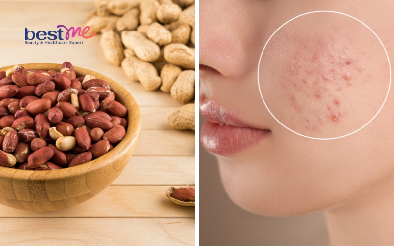 an-dau-phong-lac-co-noi-mun-khong-bi-mun-co-nen-an-lac-1 Ăn đậu phộng (lạc) có nổi mụn không? Bị mụn có nên ăn lạc? - 1