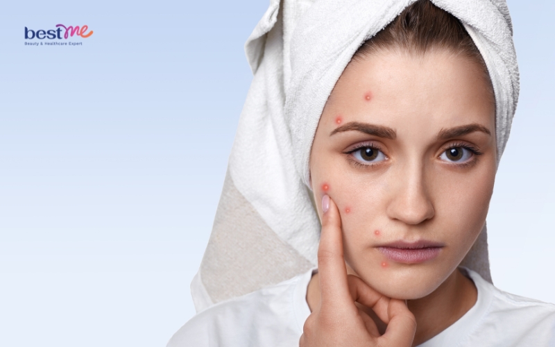 Ăn lựu có nổi mụn không? Ăn lựu mỗi ngày có tốt cho sức khỏe? - 1