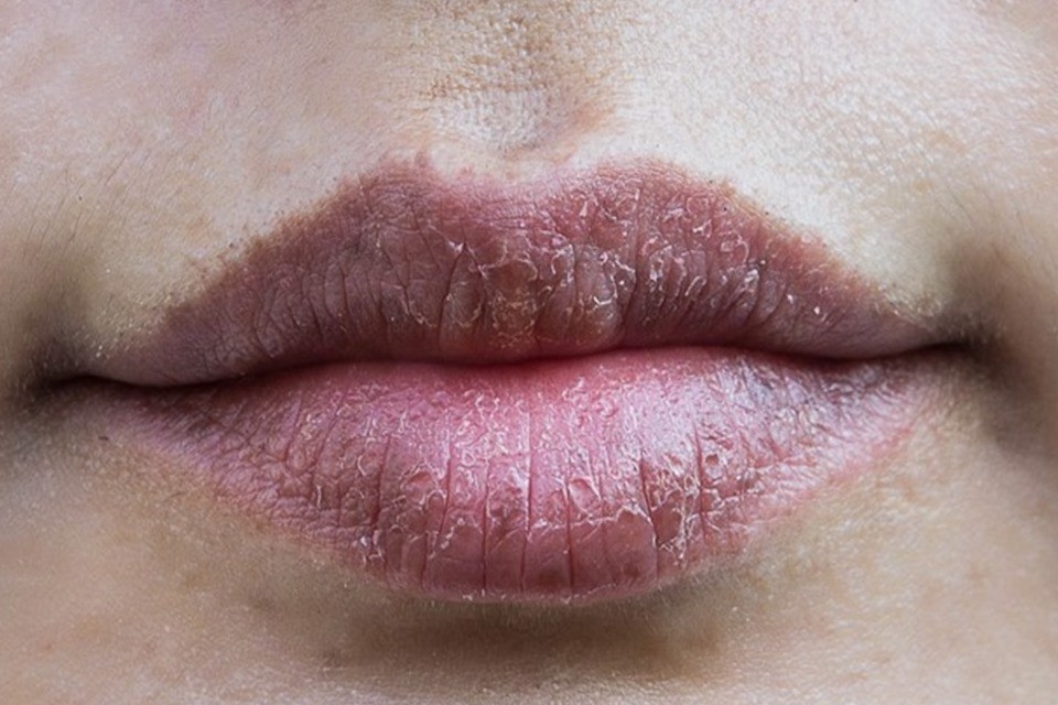 Vitamin E có công dụng gì trong việc làm trắng môi và giảm thâm sạm?
