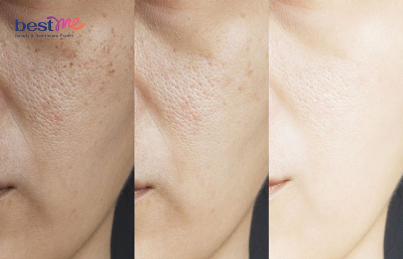 Bộ đôi niacinamide và B5 giúp thu nhỏ lỗ chân lông