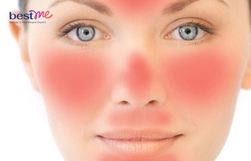 B5 làm dịu tình trạng kích ứng da