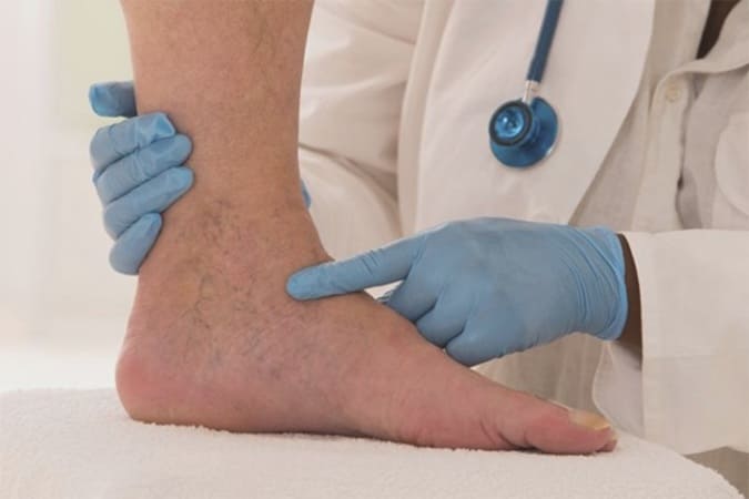 Nghẽn tĩnh mạch chân cần được điều trị sớm để không gây biến chứng nguy hiểm