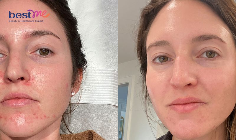 Giải đáp bao lâu thì peel da 1 lần