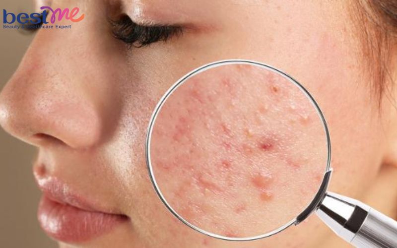 Bật mí 20 cách trị mụn bọc sưng đỏ tại nhà hiệu quả cấp tốc - 1