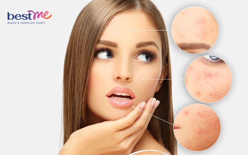 bat-mi-bi-quyet-lam-sao-de-co-da-mat-dep-khong-mun-1 Bật mí bí quyết làm sao để có da mặt đẹp không mụn - 1