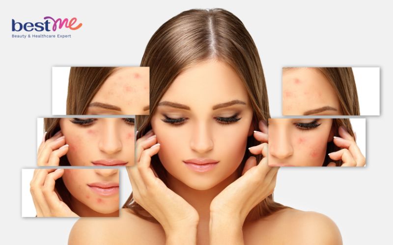 bat-mi-bi-quyet-lam-sao-de-co-da-mat-dep-khong-mun-2 Bật mí bí quyết làm sao để có da mặt đẹp không mụn - 2