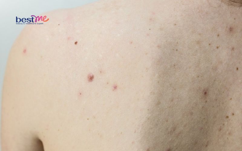 bat-mi-cach-tri-mun-boc-o-lung-hieu-qua-nhat-ngay-tai-nha-1 Bật mí cách trị mụn bọc ở lưng hiệu quả nhất ngay tại nhà - 1