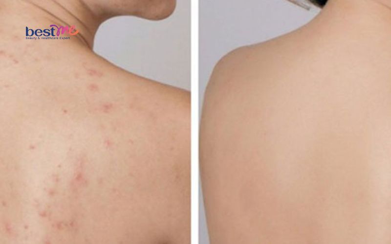 bat-mi-cach-tri-mun-boc-o-lung-hieu-qua-nhat-ngay-tai-nha-2 Bật mí cách trị mụn bọc ở lưng hiệu quả nhất ngay tại nhà - 2