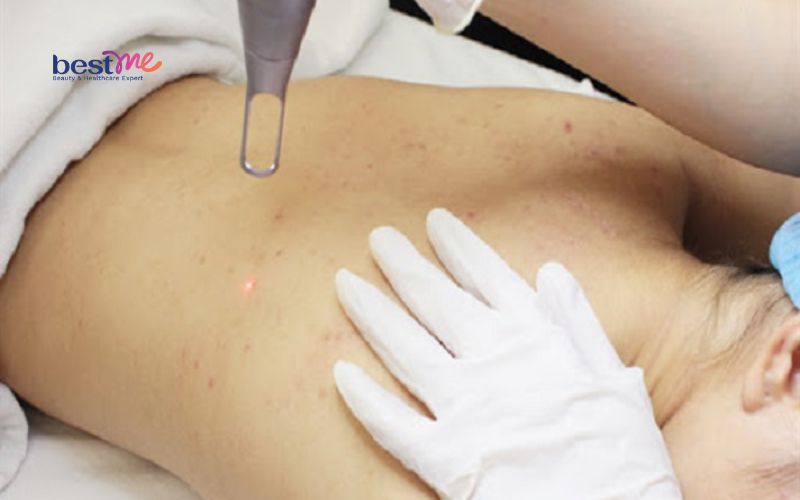 bat-mi-cach-tri-mun-boc-o-lung-hieu-qua-nhat-ngay-tai-nha-3 Bật mí cách trị mụn bọc ở lưng hiệu quả nhất ngay tại nhà - 3
