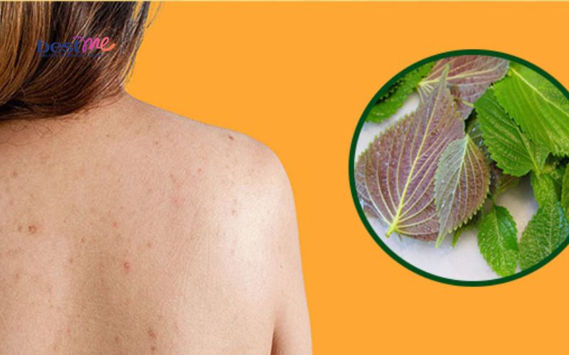 bat-mi-cach-tri-mun-boc-o-lung-hieu-qua-nhat-ngay-tai-nha-6 Bật mí cách trị mụn bọc ở lưng hiệu quả nhất ngay tại nhà - 6