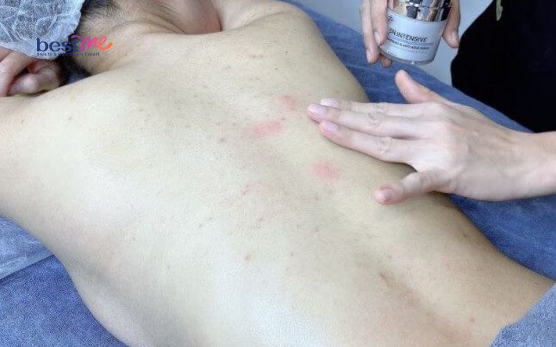 bat-mi-cach-tri-mun-boc-o-lung-hieu-qua-nhat-ngay-tai-nha-8 Bật mí cách trị mụn bọc ở lưng hiệu quả nhất ngay tại nhà - 8