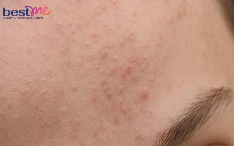 bat-mi-cach-tri-mun-cam-o-tran-hieu-qua-nhat-khong-tai-phat-2 Bật mí cách trị mụn cám ở trán hiệu quả nhất không tái phát - 2