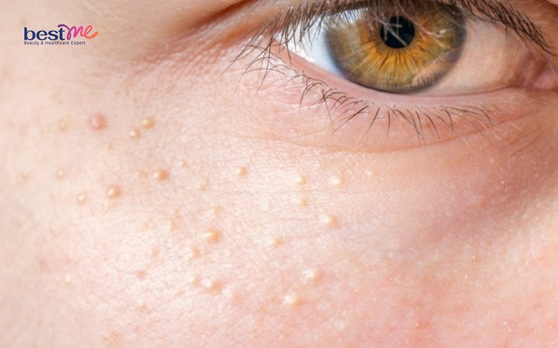 Bật mí cách trị mụn đá ở mắt, trên mặt hiệu quả nhanh nhất - 1