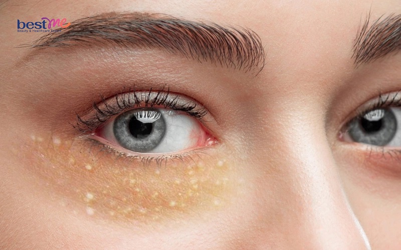 Bật mí cách trị mụn đá ở mắt, trên mặt hiệu quả nhanh nhất - 2