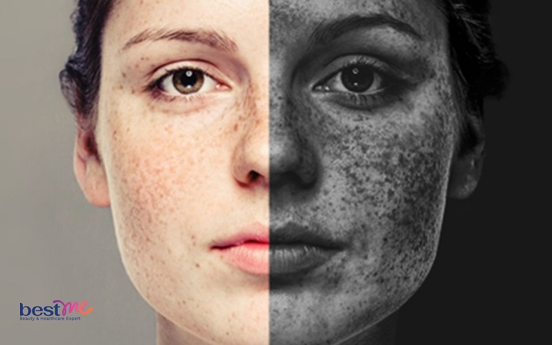 Bật mí cách trị mụn đá ở mắt, trên mặt hiệu quả nhanh nhất - 5