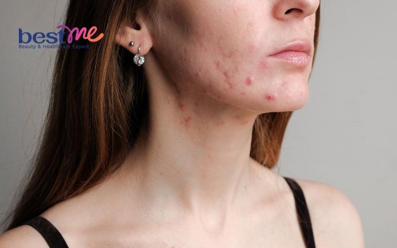 bat-mi-cach-tri-nong-gan-noi-mun-tai-nha-hieu-qua-tot-nhat-2 Bật mí cách trị nóng gan nổi mụn tại nhà hiệu quả tốt nhất - 2