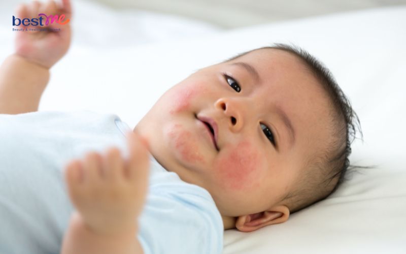 be-bi-noi-mun-dau-trang-la-benh-gi-cach-xu-ly-hieu-qua-2 Bé bị nổi mụn đầu trắng là bệnh gì? Cách xử lý hiệu quả - 2