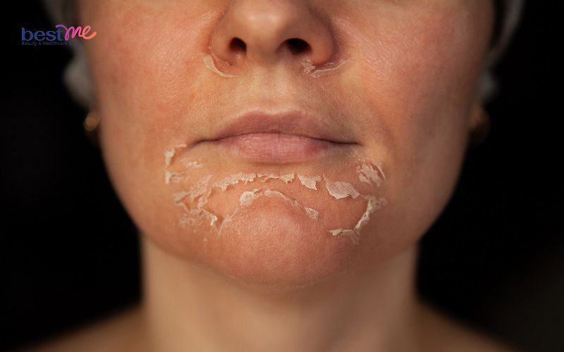 Một trong những nguyên nhân phổ biến là da mặt bị chàm khô