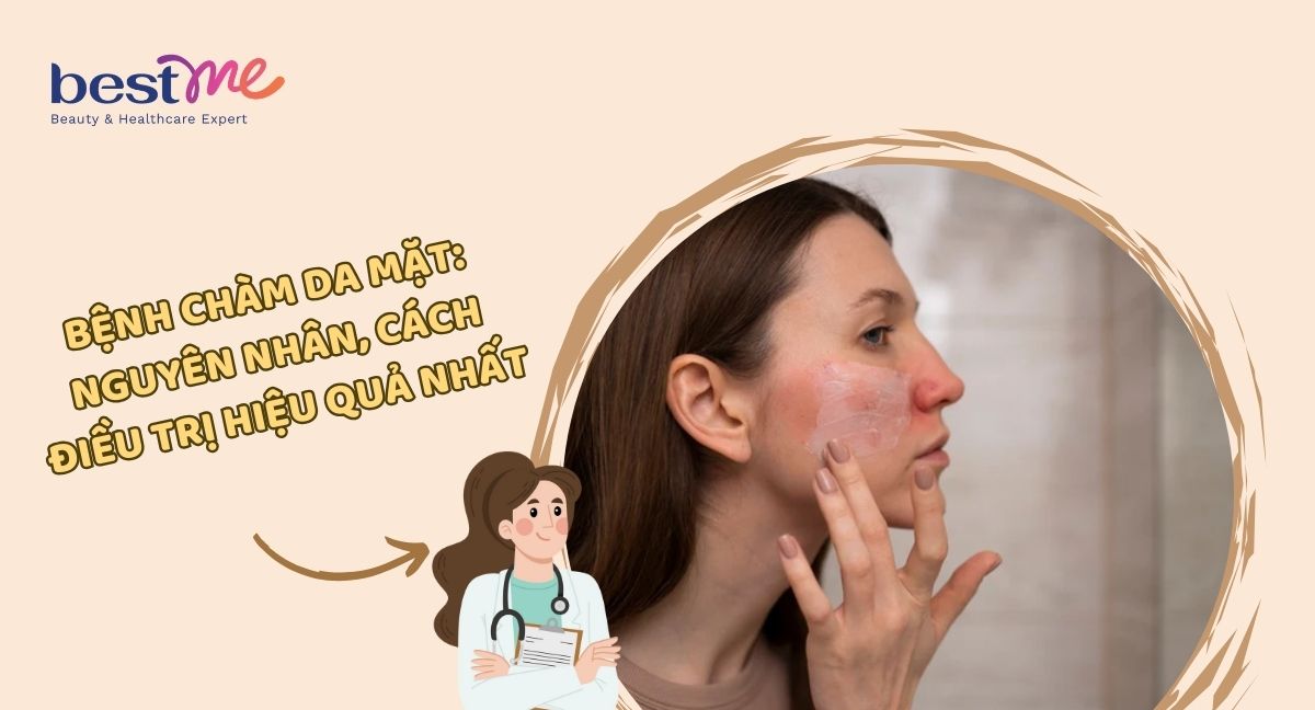 Nguyên nhân bị chàm da mặt và cách điều trị hiệu quả nhất