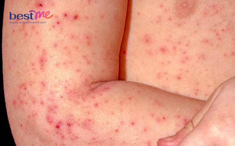Bệnh chàm nang lông là gì? Có nguy hiểm không? Cách điều trị - 1