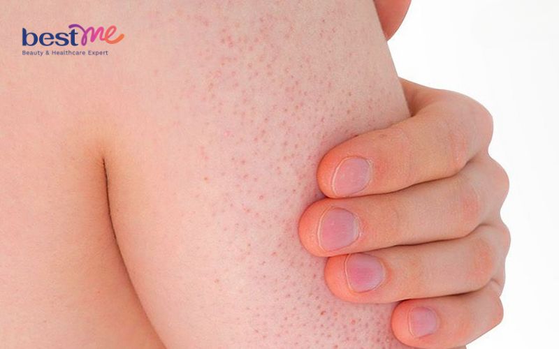 Bệnh chàm nang lông là gì? Có nguy hiểm không? Cách điều trị - 2