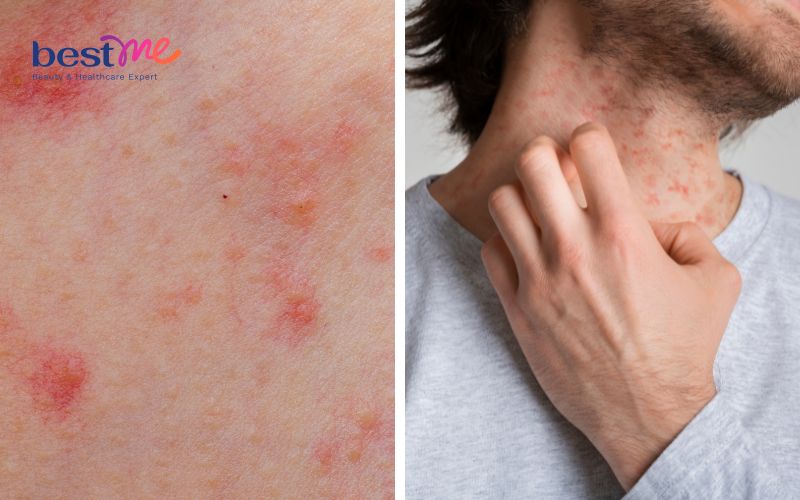 Bệnh chàm nang lông là gì? Có nguy hiểm không? Cách điều trị - 3
