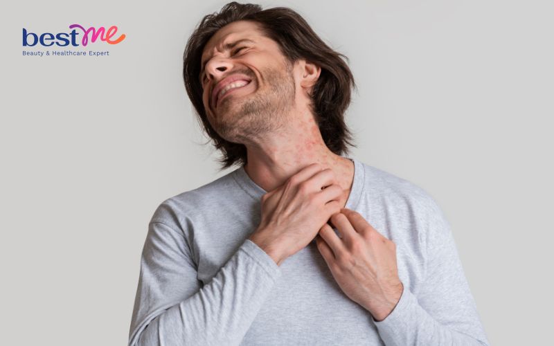 Bệnh chàm nang lông là gì? Có nguy hiểm không? Cách điều trị - 4