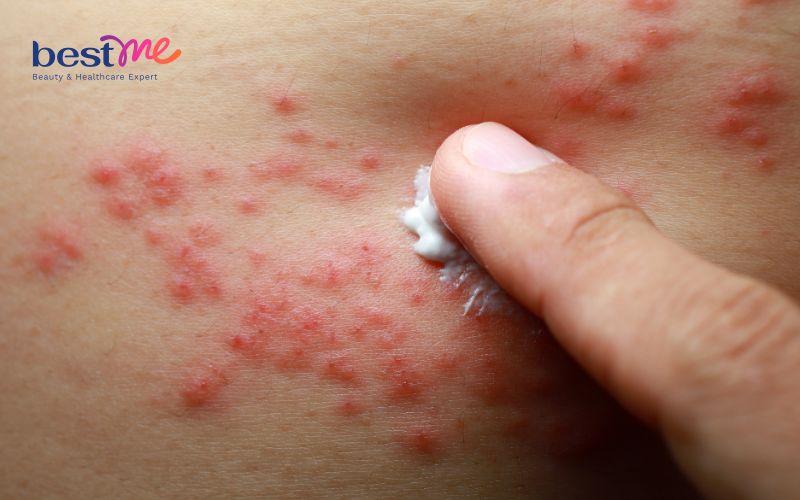 Bệnh chàm nang lông là gì? Có nguy hiểm không? Cách điều trị - 5