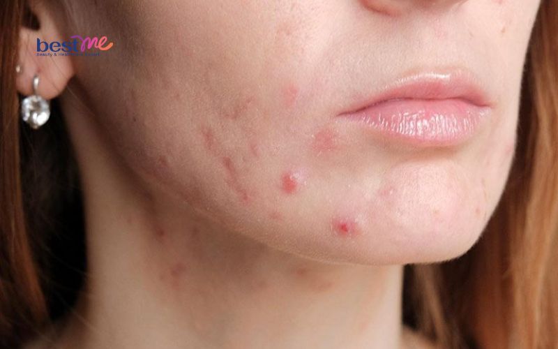 benh-mun-trung-ca-do-nguyen-nhan-va-cach-tri-hieu-qua-nhat-1 Bệnh mụn trứng cá đỏ: Nguyên nhân và cách trị hiệu quả nhất - 1