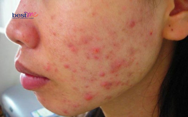 benh-mun-trung-ca-do-nguyen-nhan-va-cach-tri-hieu-qua-nhat-2 Bệnh mụn trứng cá đỏ: Nguyên nhân và cách trị hiệu quả nhất - 2