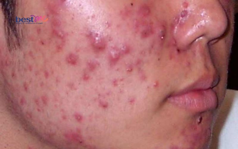 benh-mun-trung-ca-do-nguyen-nhan-va-cach-tri-hieu-qua-nhat-6 Bệnh mụn trứng cá đỏ: Nguyên nhân và cách trị hiệu quả nhất - 6