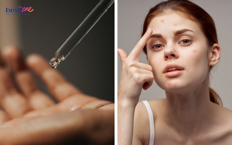 BHA kết hợp Niacinamide vô cùng hiệu quả trong việc điều trị mụn