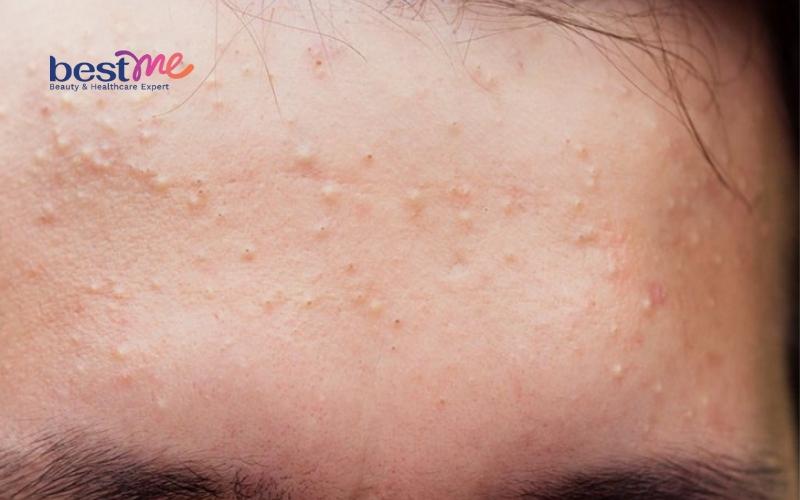 bha-tri-mun-an-co-tot-khong-cach-tri-mun-an-bang-bha-hieu-qua-2 BHA trị mụn ẩn có tốt không? Cách trị mụn ẩn bằng BHA hiệu quả - 2