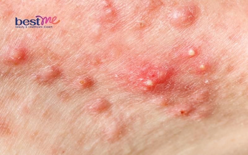 bha-tri-mun-an-co-tot-khong-cach-tri-mun-an-bang-bha-hieu-qua-3 BHA trị mụn ẩn có tốt không? Cách trị mụn ẩn bằng BHA hiệu quả - 3