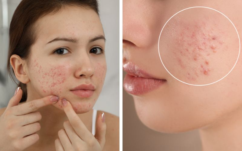 bi-day-mun-co-nen-nan-khong-nen-lam-gi-tot-va-an-toan-nhat-1 Bị đẩy mụn có nên nặn không? Nên làm gì tốt và an toàn nhất? - 1